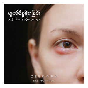 မျက်စိစွန်ရခြင်းအကြောင်းအရင်းနှင့်လက္ခဏာများ